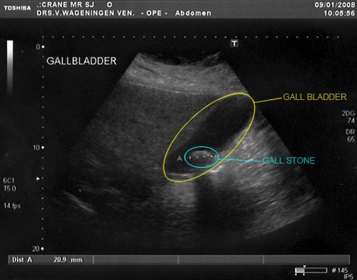 gallstone